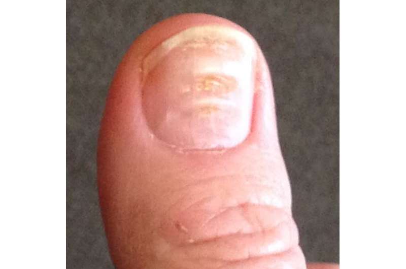 COVID nails: these changes to your fingernails may show you've had coronavirus