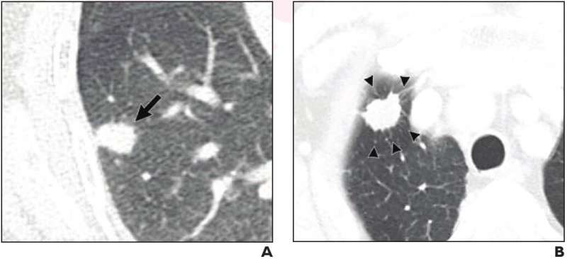 CT promising for sublobar resection in early-stage non-small cell lung cancer