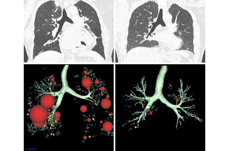 CT scans suggest possible lung destruction in some asthmatics