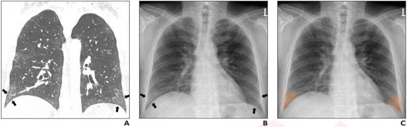 Deep learning for reticular opacity on chest radiographs with interstitial lung disease