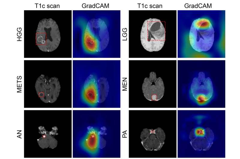 Deep learning model classifies brain tumors with single MRI scan