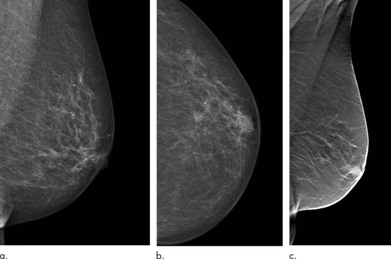 指状乳腺层析成形术降低间隔期癌症的发病率