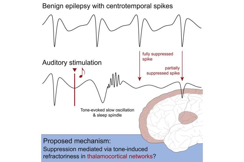 Disordered brain activity in Rolandic epilepsy can be influenced by brief sounds during sleep