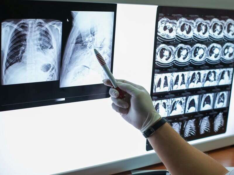 Disparities in lung cancer screening eligibility still exist