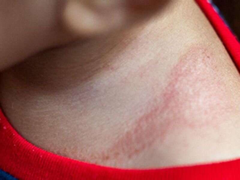 Drug could be promising new option against eczema