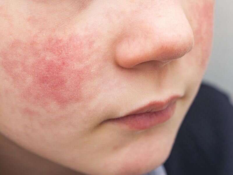Eczema can take toll on child's mental health