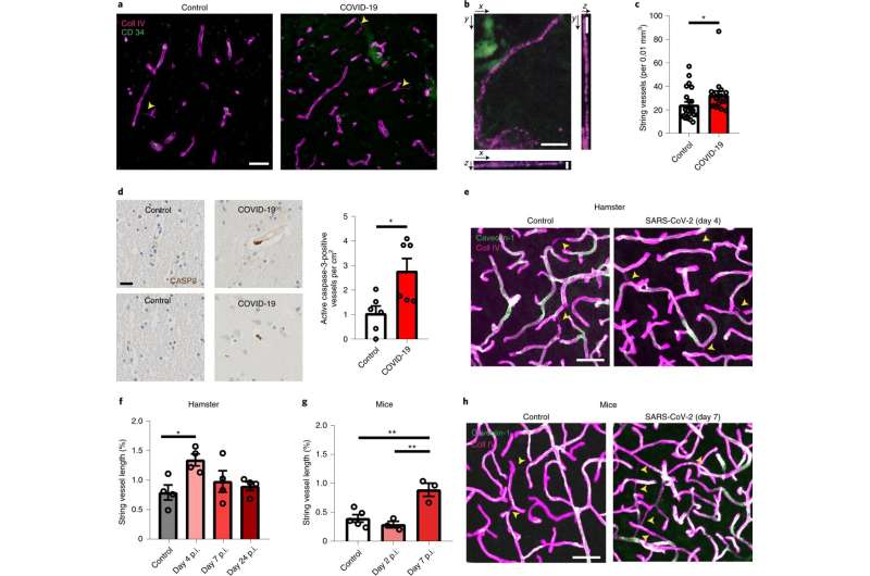 Evidence suggests SARS-CoV-2 virus attacks brain endothelial cells
