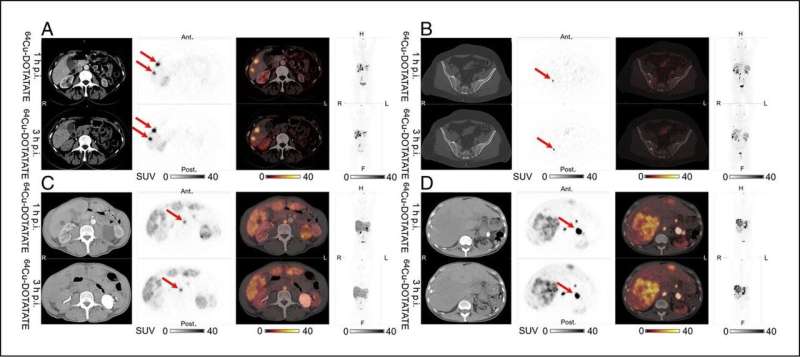 Expanded PET imaging time window adds flexibility for neuroendocrine tumor patients