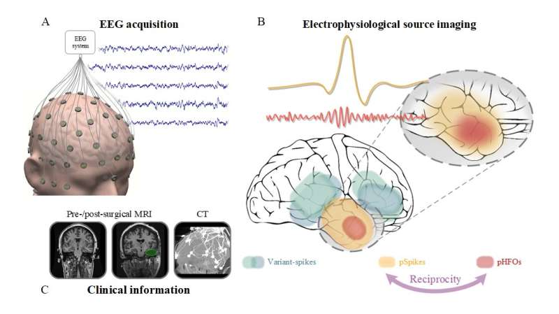 快速脑波振荡识别和本地化癫痫大脑