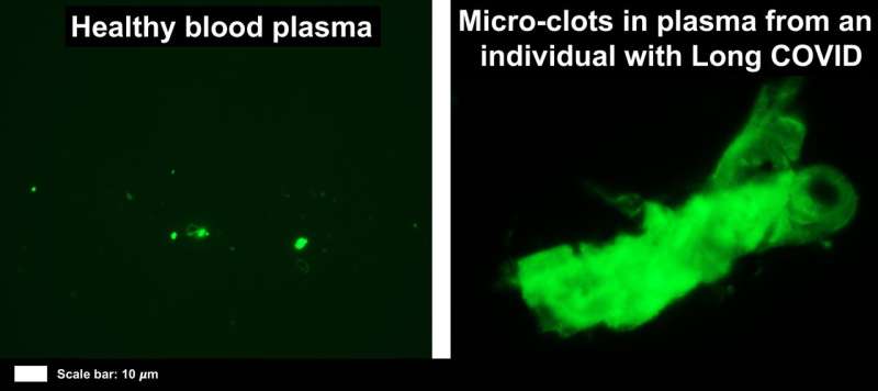 First evidence of inflammatory micro clots in blood of individuals suffering from Long COVID