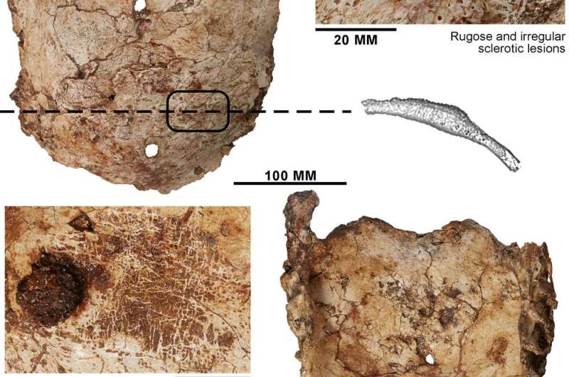Fossil find reveals giant prehistoric ‘thunder birds’ were riddled with bone disease