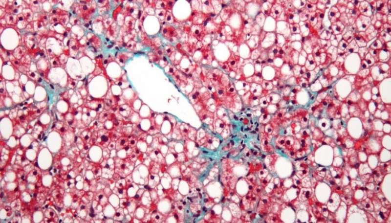 Genes discovered that regulate level of harmful fatty substances in liver