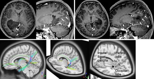 Glioma invasion may be affected by the parietooccipital fissure and white matter fibers rather than being a random phenomenon
