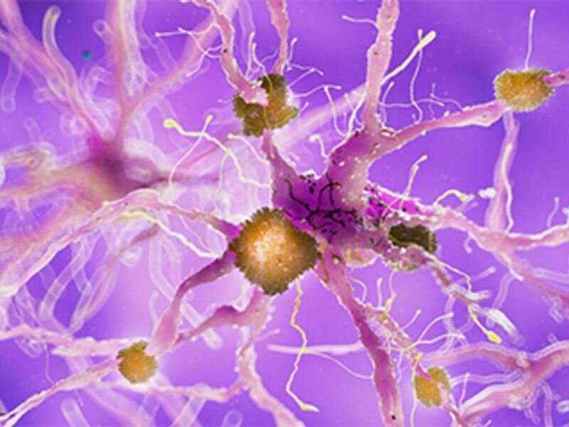 Good news, bad news from alzheimer's vaccine trial