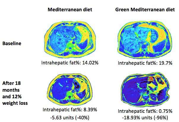 Green Mediterranean diet cuts non-alcoholic fatty liver disease by half thumbnail