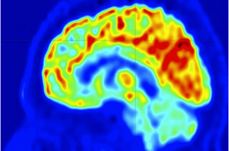 Imaging approach to stop epilepsy seizures