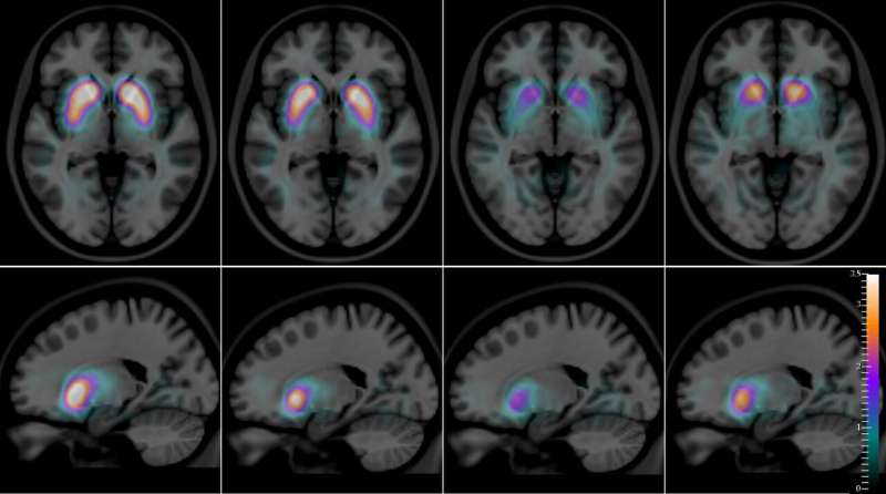 Imaging of a living brain can help clearly differentiate between two types of dementia
