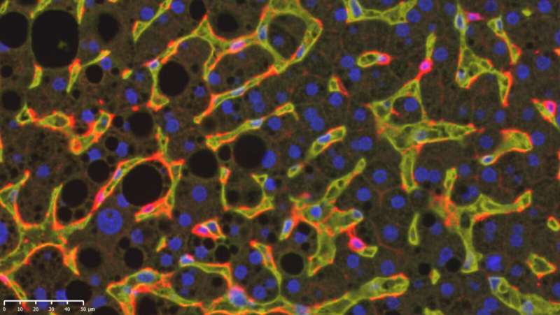 Immune cells promote proinflammatory fatty liver disease
