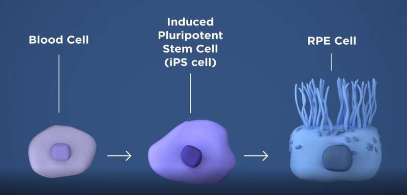 Induced pluripotent stem cells reveal causes of disease