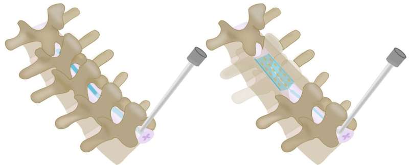 Inflatable, shape-changing spinal implants could help treat severe pain