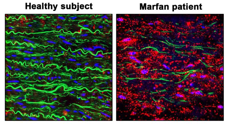 Inhibition of proteins activated by nitric oxide reverses aortic aneurysm in Marfan syndrome