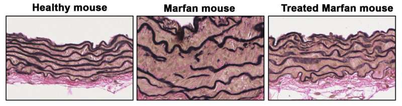 Inhibition of proteins activated by nitric oxide reverses aortic aneurysm in Marfan syndrome