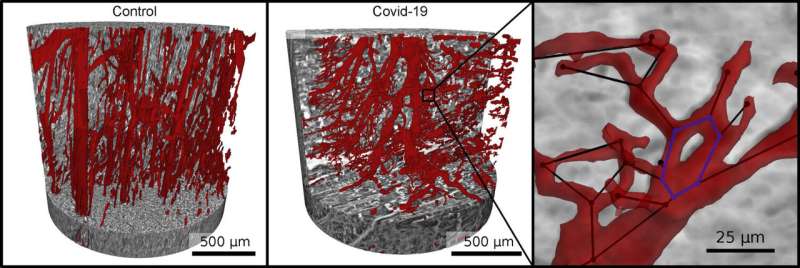 Innovative X-ray imaging shows Covid-19 can cause vascular damage to the heart
