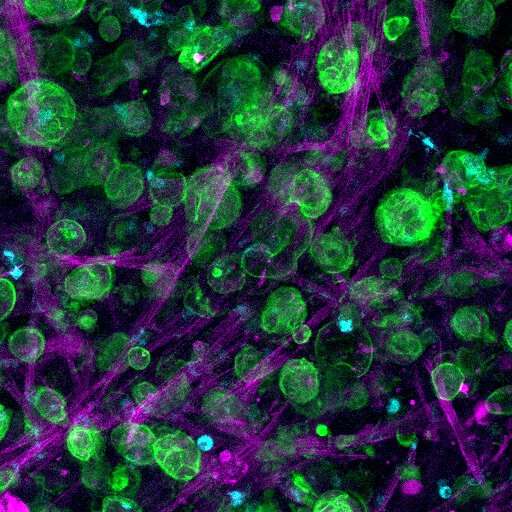 Lab grown tumor models could improve treatment for pancreatic cancer