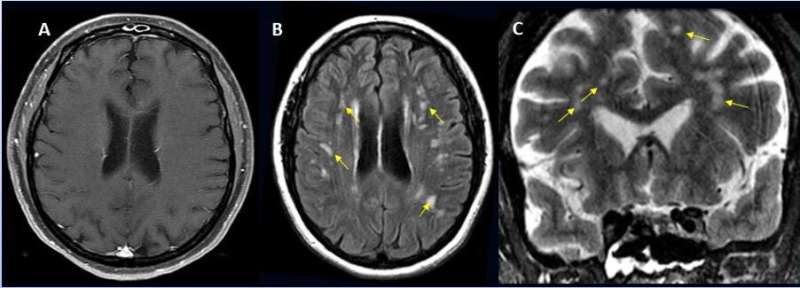 Large international study reveals spectrum of COVID-19 brain complications