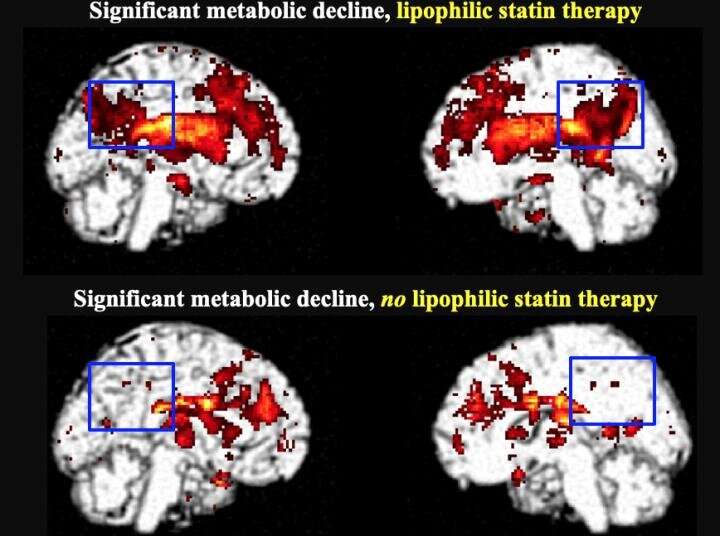 Lipophilic statin use linked to increased risk of dementia