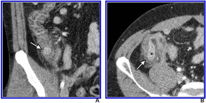 低剂量CT用于右结肠憩室炎的替代诊断阑尾炎