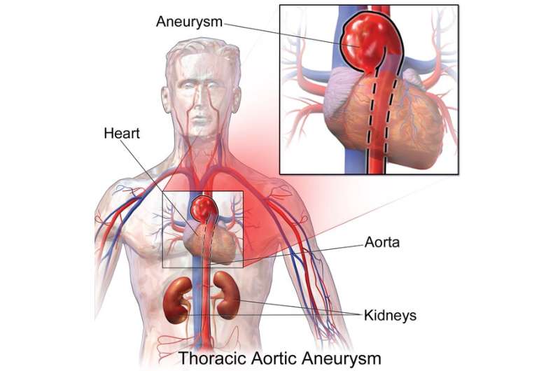 Machine learning may help identify people at risk of thoracic aortic aneurysm