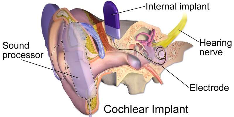 Method converts cochlear implant electrodes into microsensors