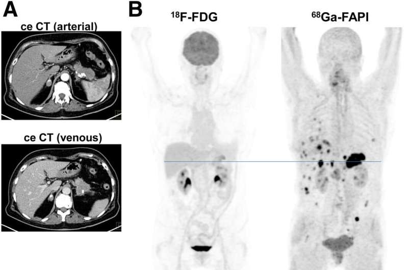 Molecular imaging improves staging and treatment of pancreatic ductal adenocarcinomas