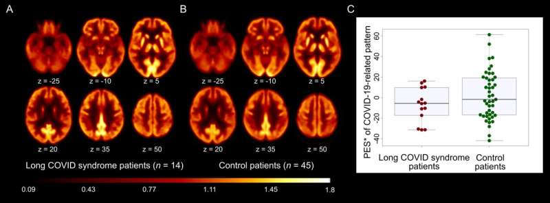 Molecular Imaging Suggests Long-COVID Symptoms May Be Caused by Fatigue, Not Regional Brain Dysfunction