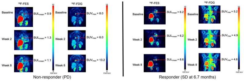 Molecular imaging determines effectiveness of novel metastatic breast cancer treatment