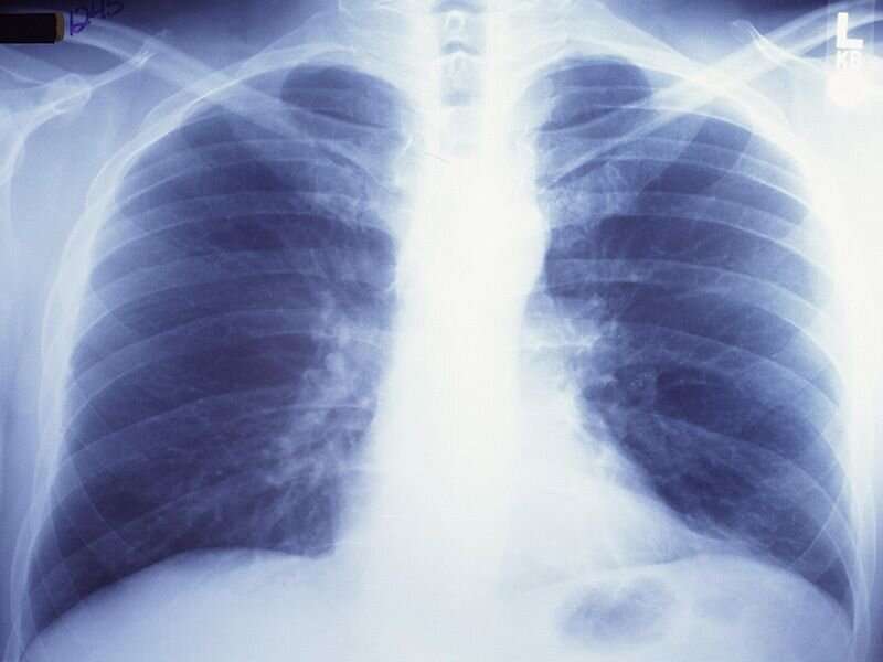 根据新的指导方针，更多的美国人将接受肺癌筛查