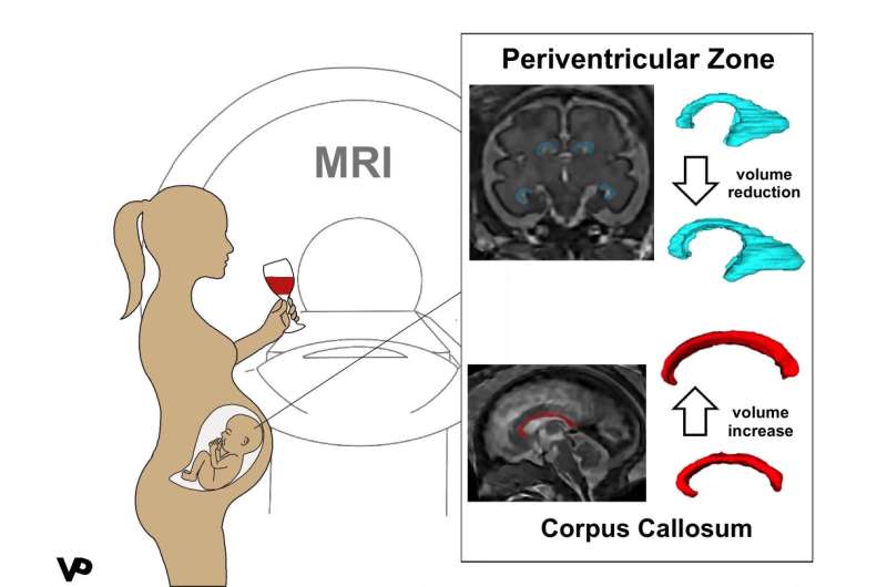 MRI reveals altered brain structure in fetuses exposed to alcohol