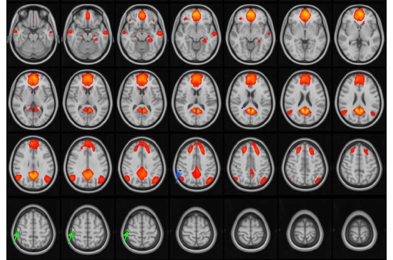 Multiple concussions can disrupt brain connectivity in teens