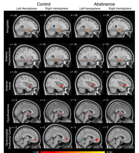 神经成像研究发现大脑回路的改变导致了酒精使用障碍