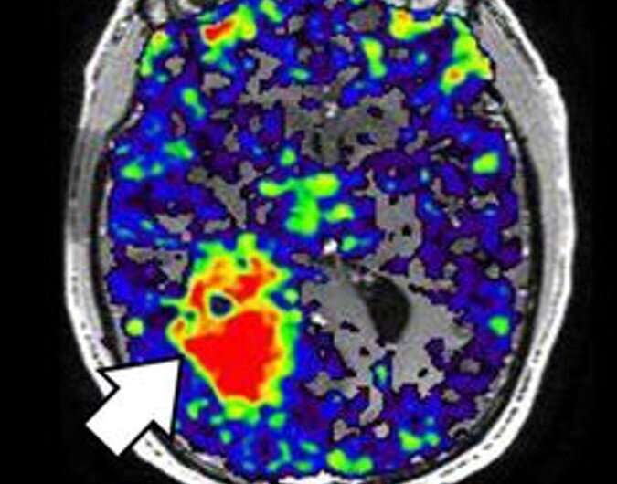 Neuroinflammation protein linked to worse survival in men with glioblastoma