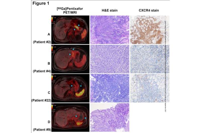 New imaging method for the detection of gastric lymphomas