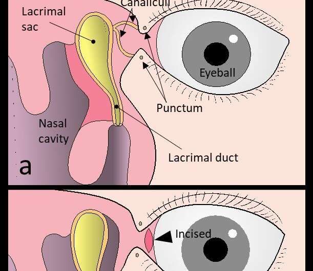 New surgical procedure developed to cure watery eyes