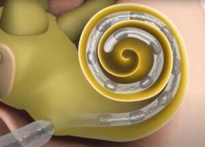New tool helps ‘tune’ cochlear implants to improve hearing