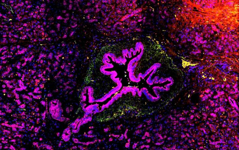 New insights on how inflammatory molecule contributes to skin and pancreatic cancers