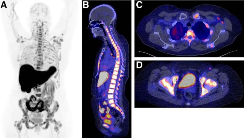 Newly approved PET imaging agent solves clinical dilemmas in breast cancer patients