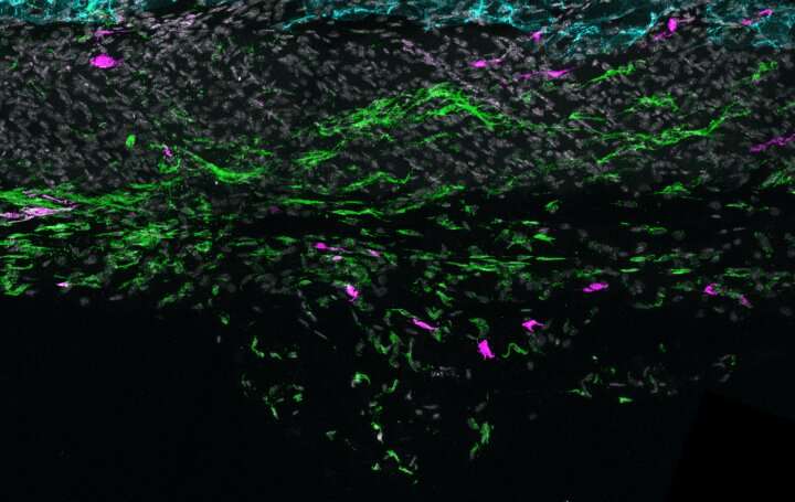 Newly discovered skin cell may underlie inflammatory skin disease