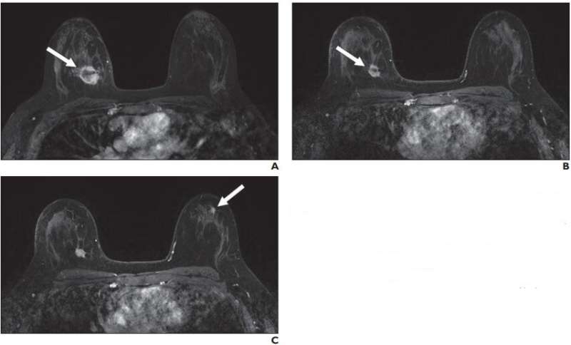 New suspicious lesions on breast MRI in neoadjuvant therapy