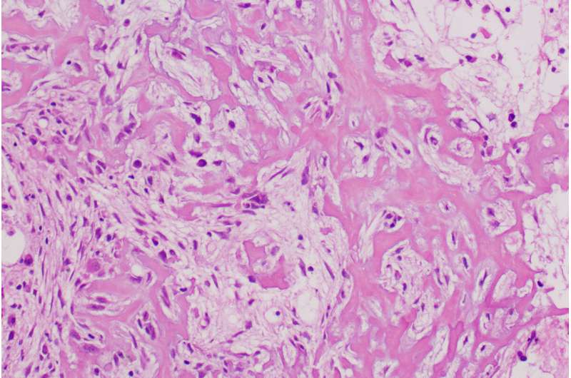 Nixing bone cancer fuel supply offers new treatment approach, mouse study suggests