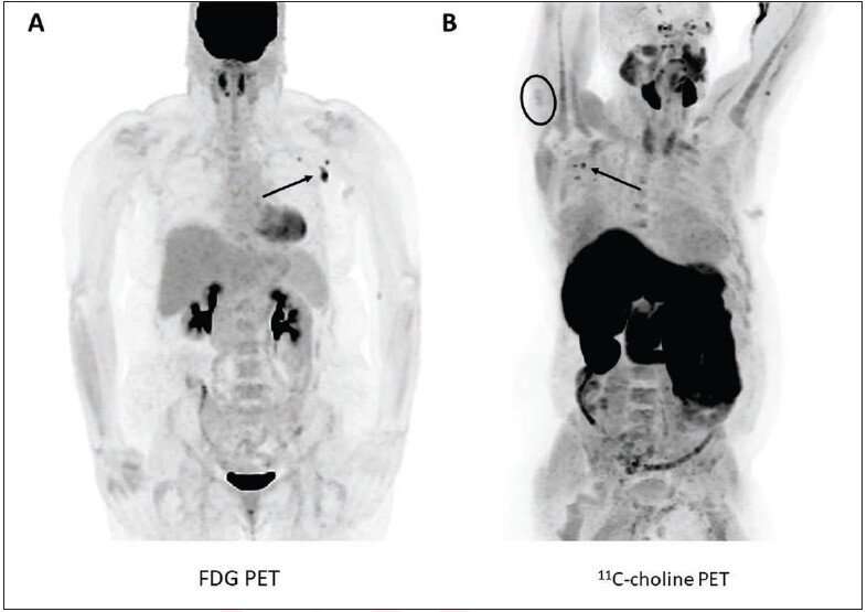 Nodal and deltoid radiotracer uptake on post-COVID-19 vaccination PET
